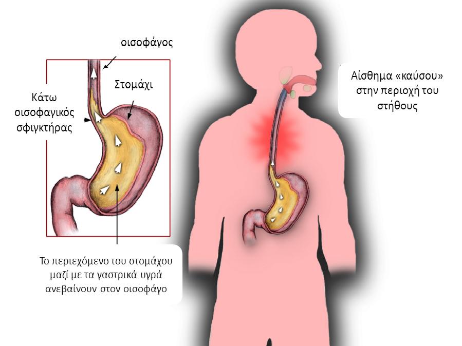 sophageal reflux